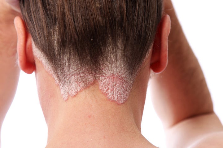 An example of psoriasis on the hairline and on the scalp.