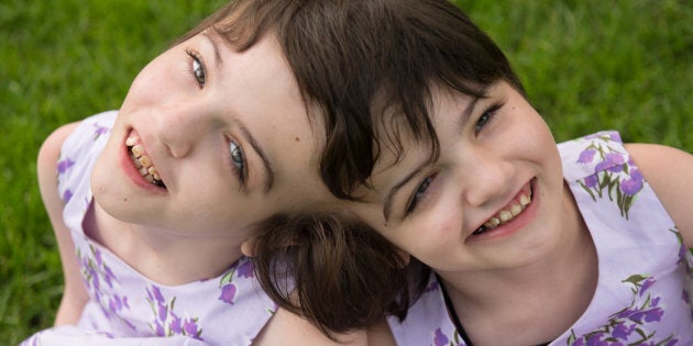 Tatiana and Krista Hogan are craniopagus twins who live with their family in Vernon, B.C.