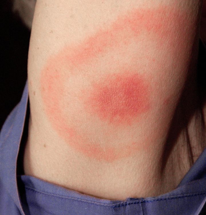 Any unusual rash after a tick bite should be checked out by a doctor.