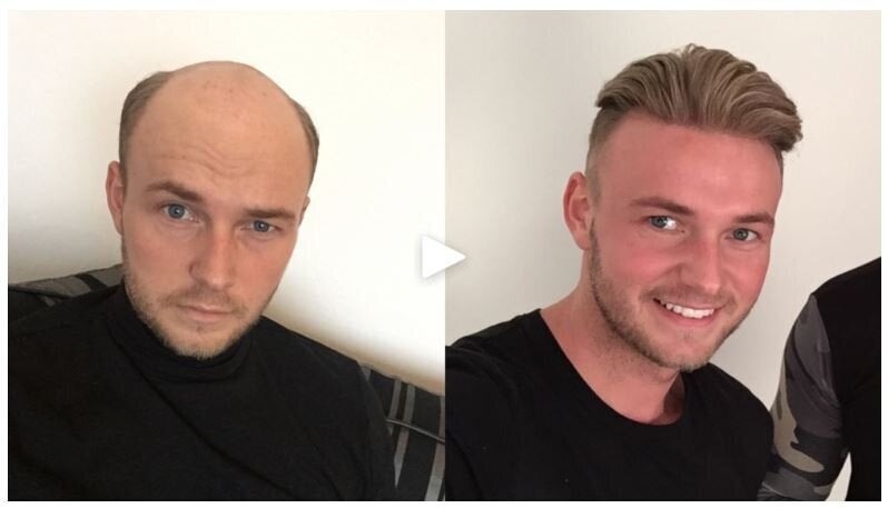 best toupees in the world