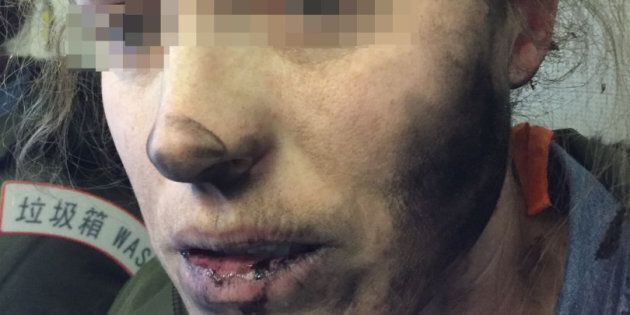 The unidentified woman suffered burns to her face and neck.