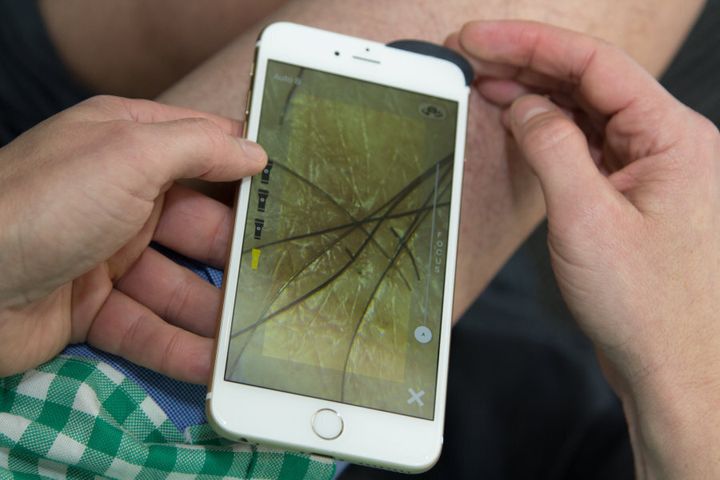 The SkinView app is designed to detect skin cancers via smartphone in real time.