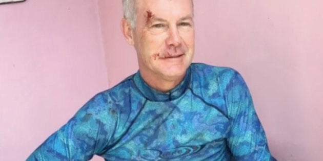 Dr. Steven T. Cutbirth of Waco, Texas, showed off some gnarly wounds after being attacked by a bull shark in the Bahamas.