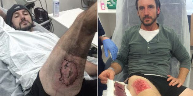 Gareth Clear's injury and his skin graft.
