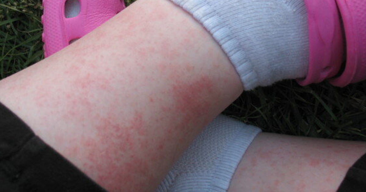 How To Treat Heat Rash | HuffPost Life