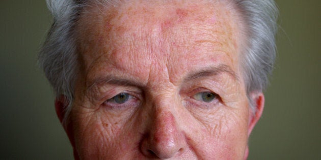 Rosacea is a common but often misunderstood condition that is estimated to affect over 45 million people...