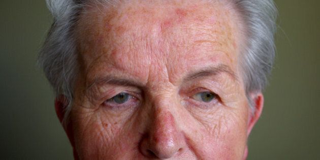 Rosacea is a common but often misunderstood condition that is estimated to affect over 45 million people worldwide. It affects fair-skinned people of mostly north-western European descent, and has been nicknamed the curse of the Celts by some in Ireland. I