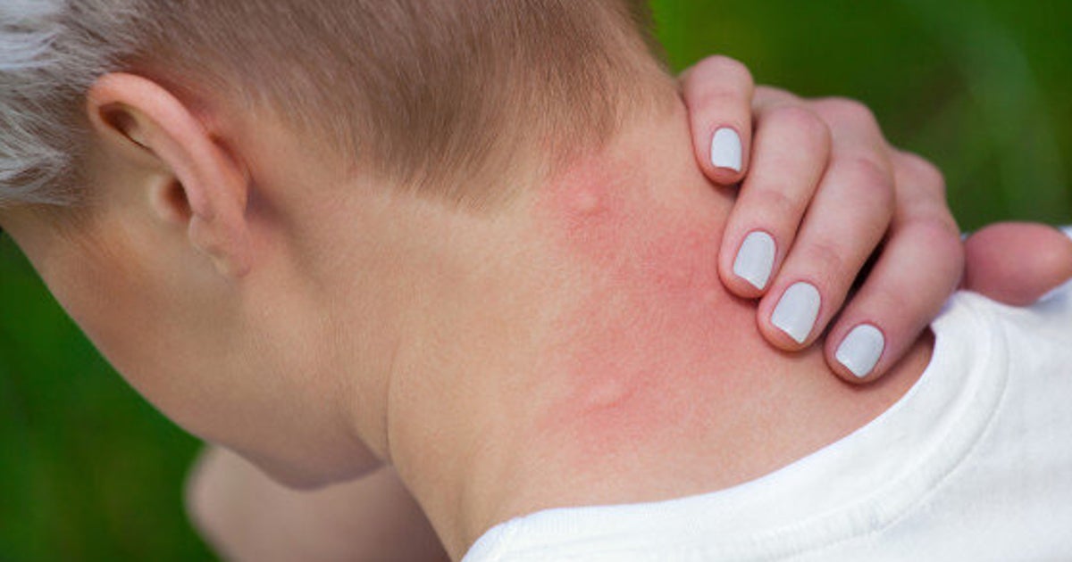 How To Prevent Mosquito Bites Outside And Indoors HuffPost Life