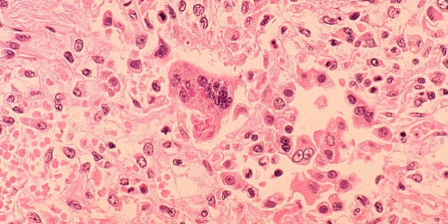 1972: In this handout from the Centers for Disease Control and Prevention (CDC), a histopathology of measles pneumonia is seen in this microscope image from 1972. Measles outbreaks have been reported throughout the U.S., with the latest reported February 5, 2015 at a daycare in suburban Chicago where as many as five children under the age of one have been infected. (Photo by CDC via Getty Images)