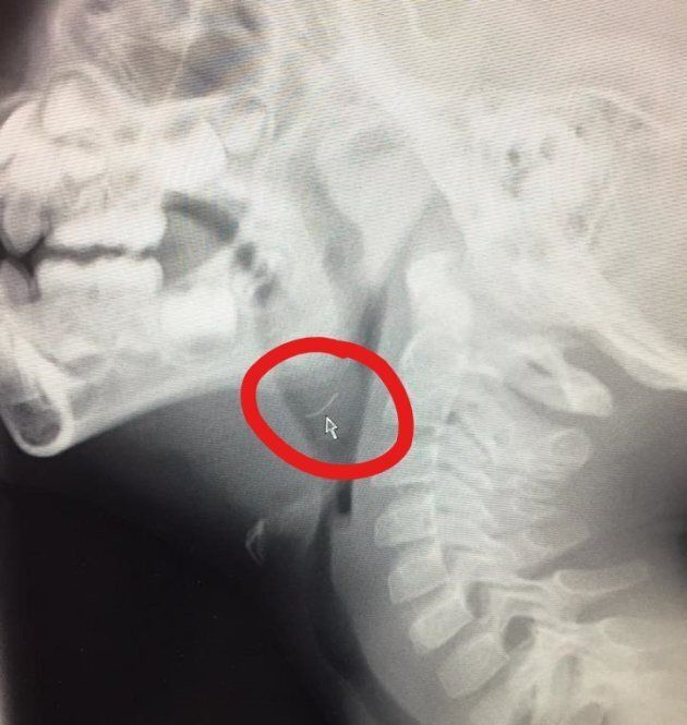 Ollie's x-ray showed he had a 1.5 cm metal bristle from a barbecue brush lodged in his throat.