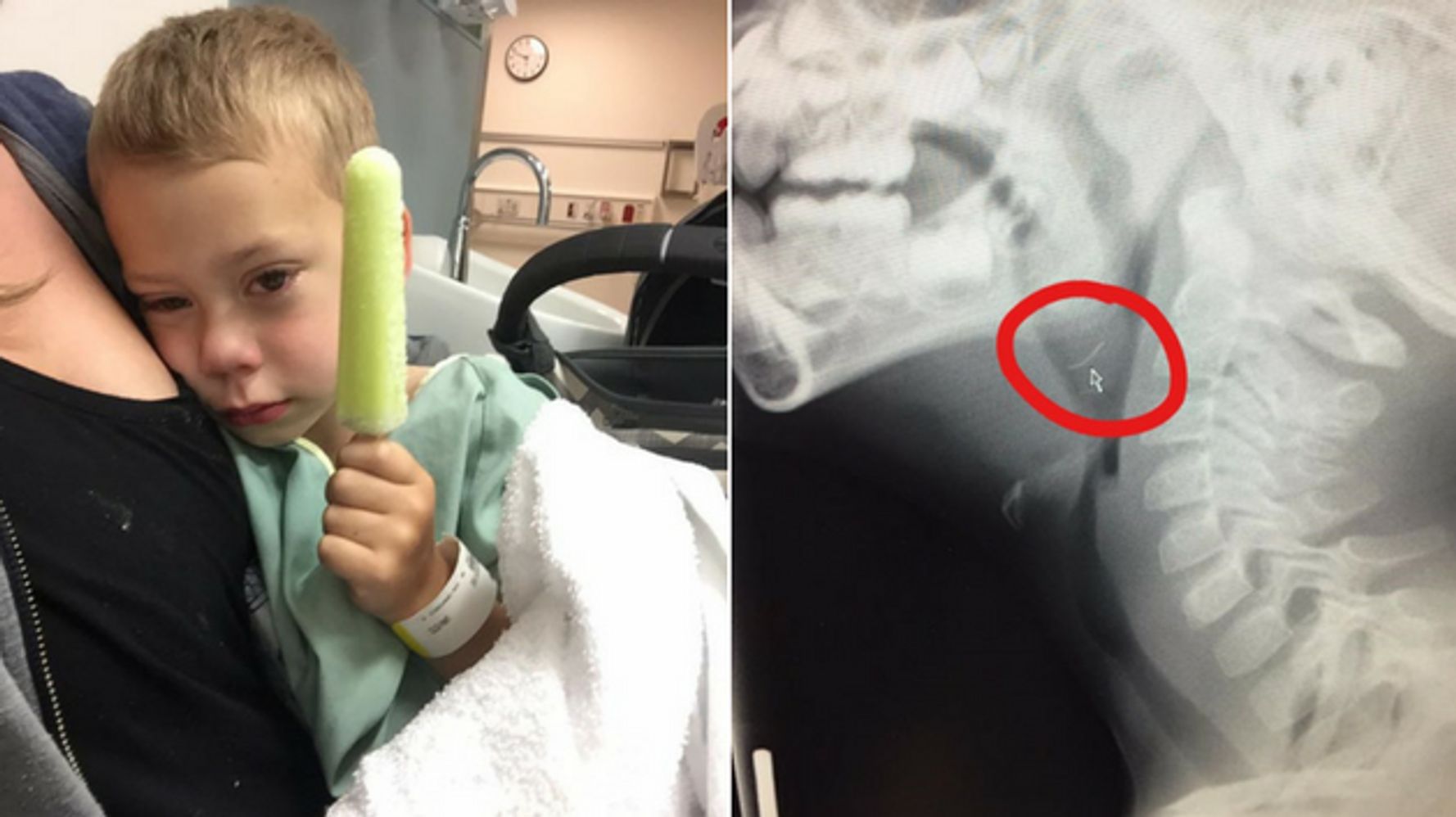 Wire from grill brush gets lodged in child's throat