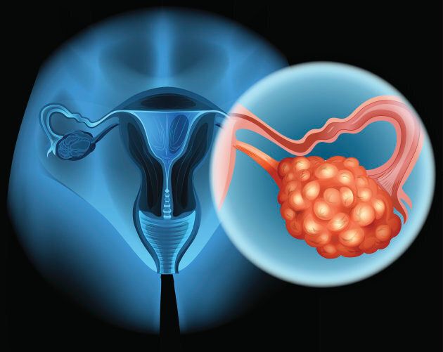 Ovarian cancer in human illustration