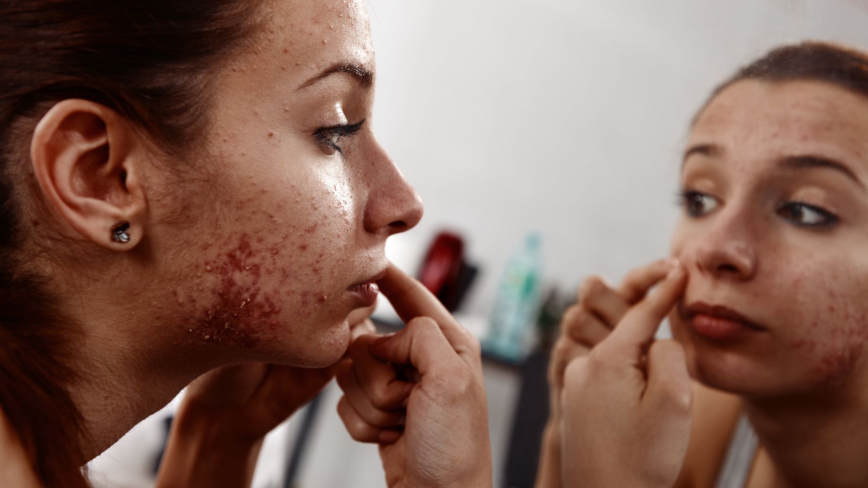 acne-can-affect-your-mental-health-but-there-is-a-lot-of-help-out