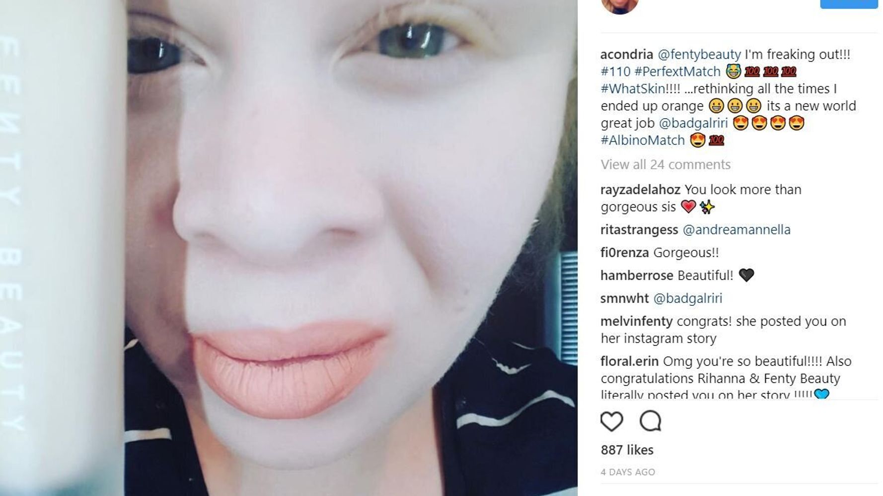 Fenty Beauty Foundation Gets Viral Review From Albino Woman