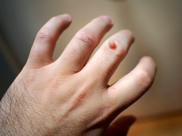 Warts can appear on fingers.