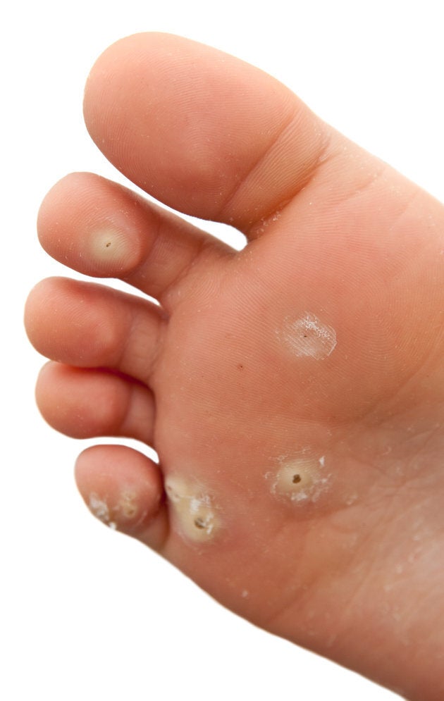 Plantar warts.