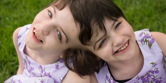 Tatiana and Krista Hogan are craniopagus twins who live with their family in Vernon, B.C.