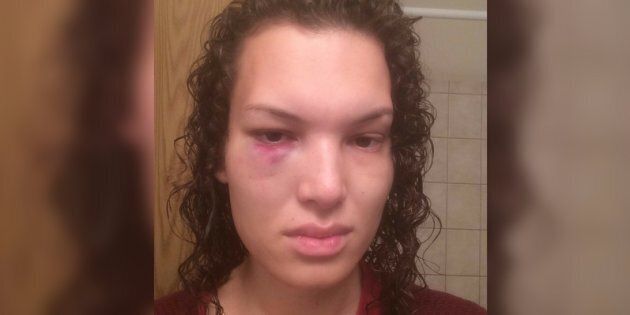 Aisha Walker says she was left with a black eye and seven shattered teeth after being punched by a stranger on Winnipeg bus on Saturday.