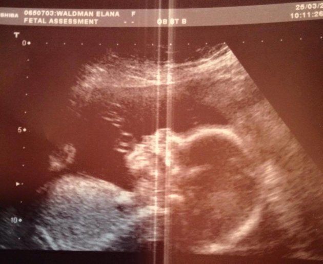 An ultrasound image of the couple's daughter, Kaia.