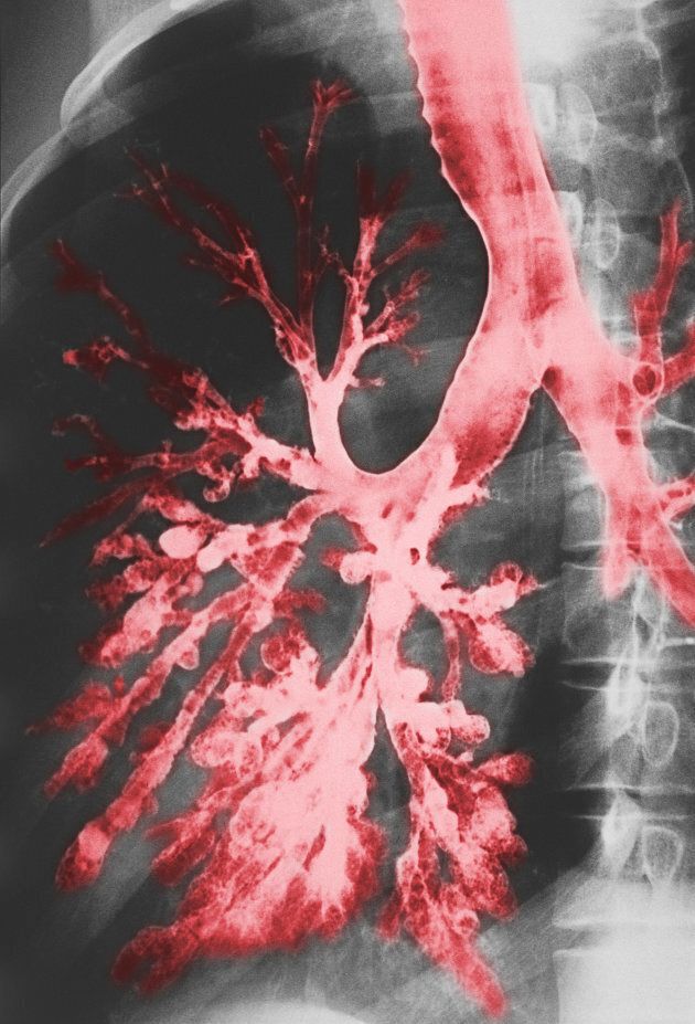 Bronchi and bronchioles are the airways of the lungs, seen here in red.