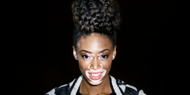 Top model Chantelle Brown-Young, known as Winnie Harlow, displays a Spring/Summer design by Desigual at Madrid's Fashion Week in Madrid, Spain, Friday, Feb. 6, 2015.(AP Photo/Daniel Ochoa de Olza)