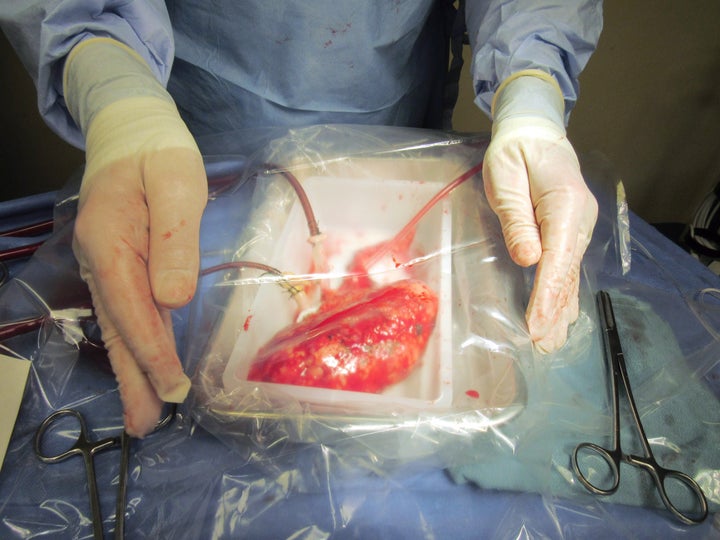 A kidney is seen during a transplant in this undated handout photo. Researchers at Toronto General Hospital have developed an outside-the-body perfusion system to rejuvenate less-than-ideal donor kidneys with the aim of boosting the number of organs available for transplant.