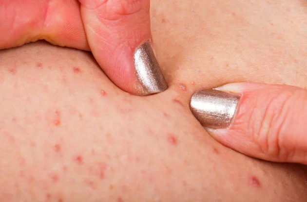 What Is Hidradenitis Suppurativa? Don't Ignore Those Lumps | HuffPost Latest News What Is Hidradenitis Suppurativa? Don't Ignore Those Lumps | HuffPost Latest News