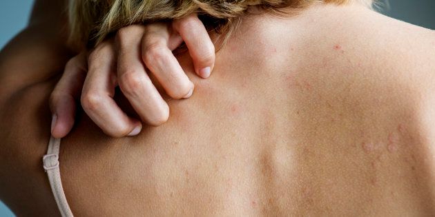 This painful skin condition can cause itchiness.
