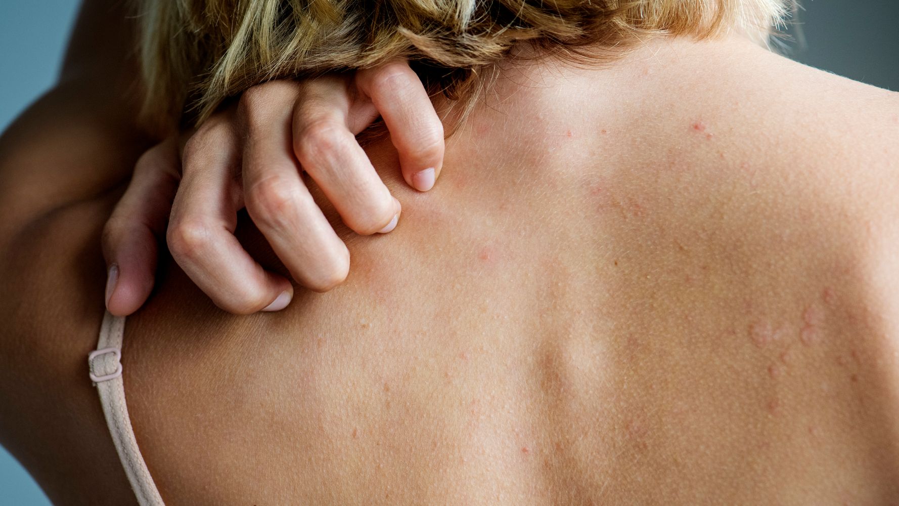 What Is Hidradenitis Suppurativa? Don't Ignore Those Lumps | HuffPost  Latest News