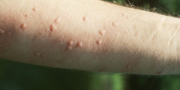 Heat hives are usually very itchy, but try not to scratch!
