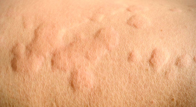 Allergic reaction heat rash  What causes it and how is it treated