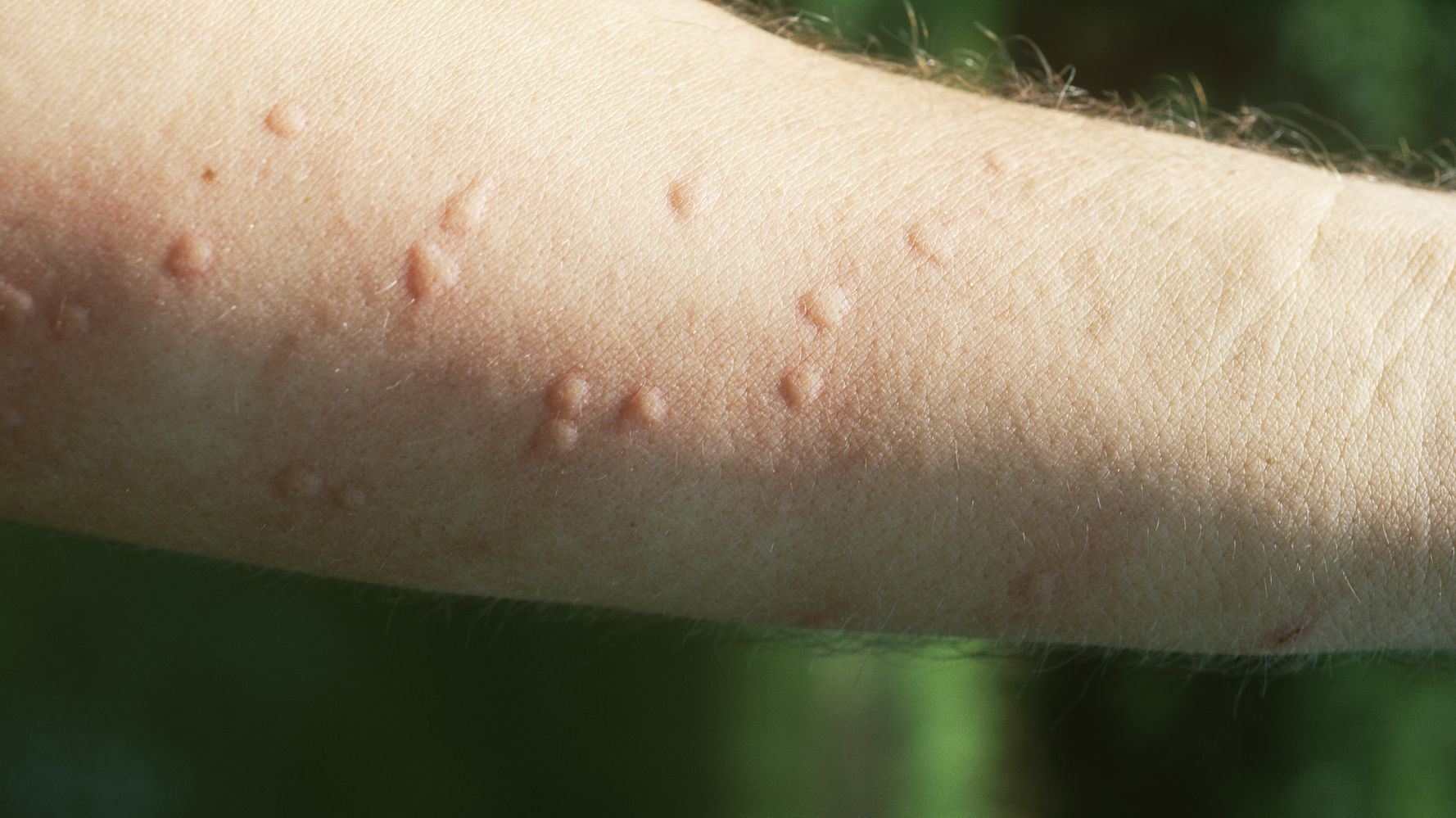 What Are Heat Hives And How Do You Get Rid Of Them Huffpost Canada Life