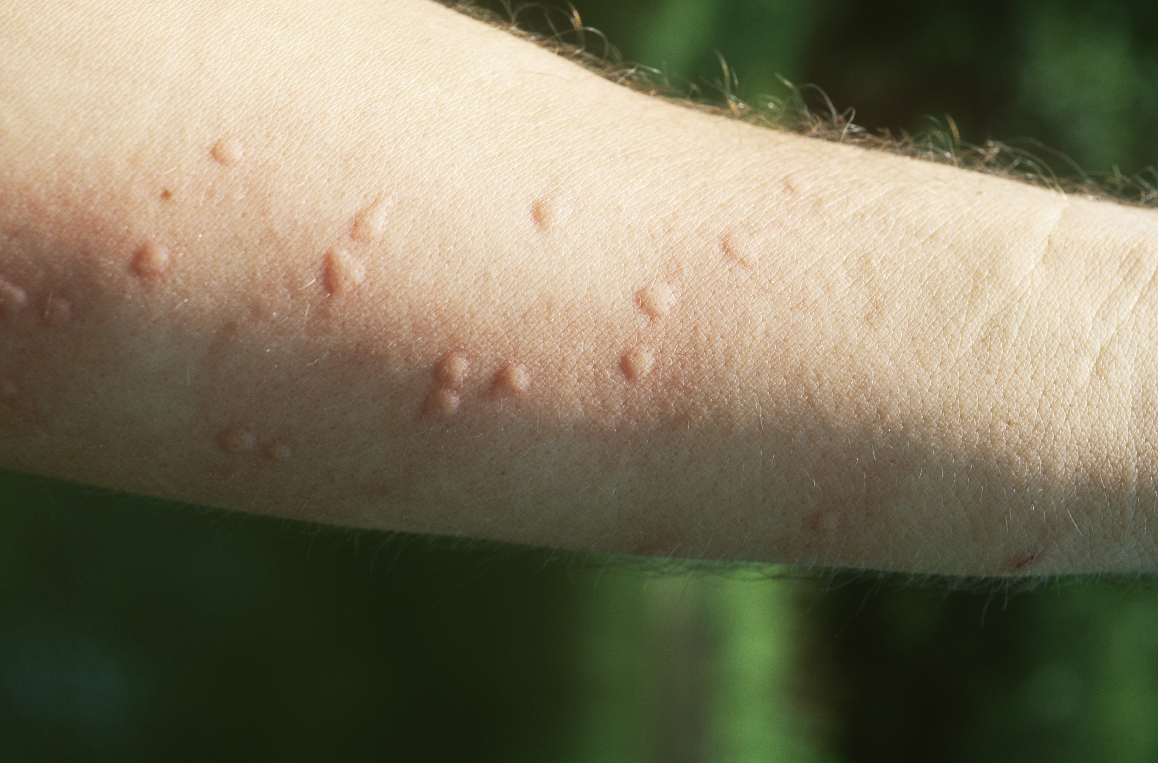 What Are Heat Hives And How Do You Get Rid Of Them HuffPost