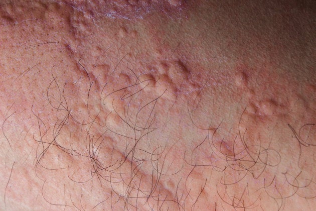 Allergic reaction heat rash  What causes it and how is it treated