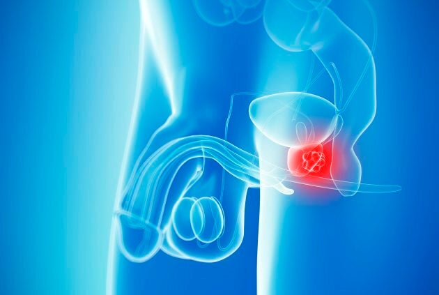 One in seven men will develop prostate cancer.