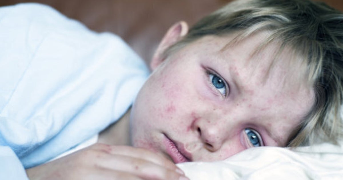 Measles Outbreak Canada 10 Facts You Need To Know HuffPost Parents