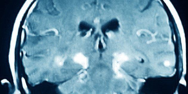 Parkinsons Disease, MRI (Photo by: BSIP/UIG via Getty Images)
