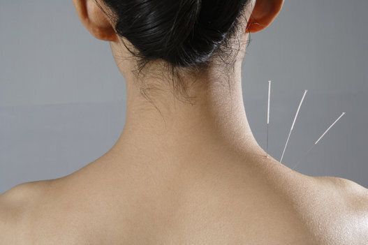 <strong>Acupuncture</strong>