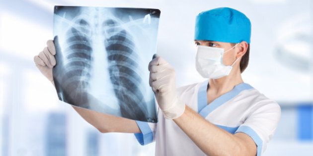 medical doctor looking at x-ray picture of lungs in hospital