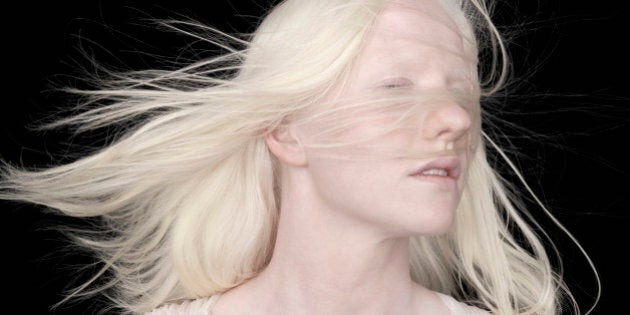 Albino woman