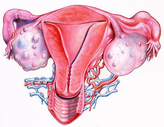 What Are Ovarian Cysts