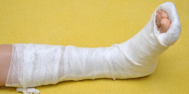 patient with broken leg in cast
