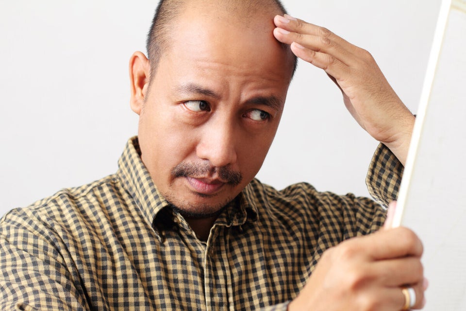 Why Short Men Are More Likely to Go Bald