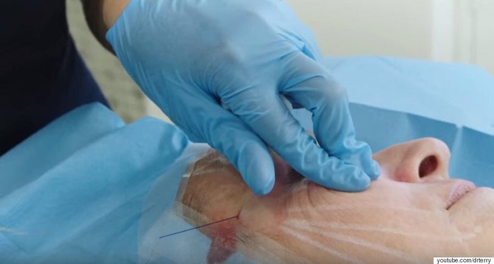 'Threads Of Life' Facelift Is Horrifying, Yet Fascinating (GRAPHIC ...