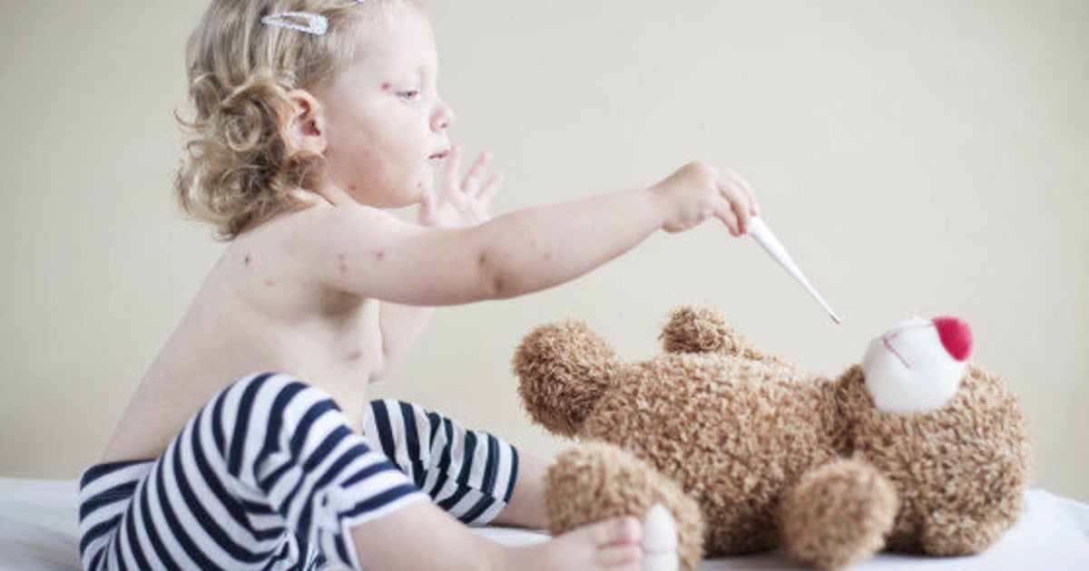 Measles Outbreak Canada 10 Facts You Need To Know HuffPost Life