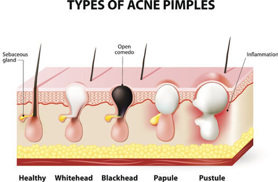 8 Questions You Have About Blackheads Answered HuffPost Life