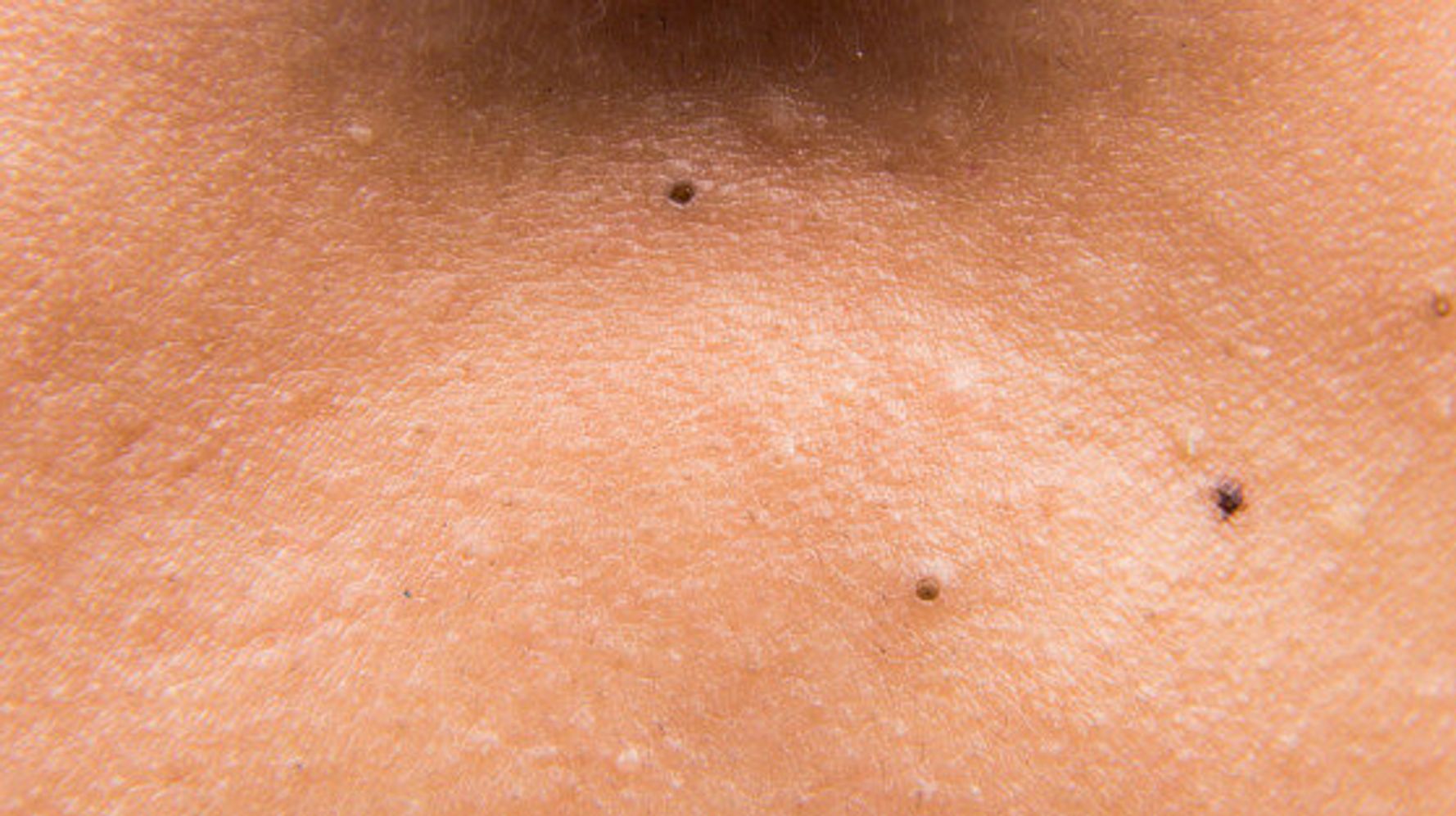 8 Questions You Have About Blackheads Answered Huffpost Life