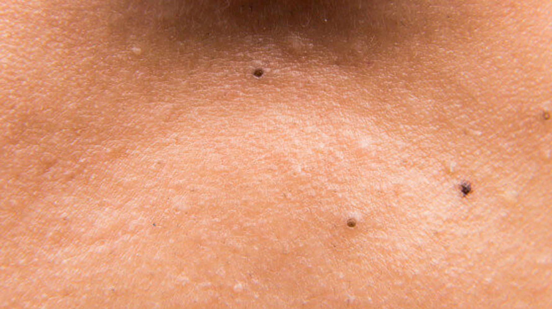 get-rid-of-blackheads-the-ultimate-guide-realself-news