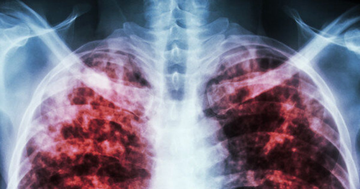 World Tuberculosis Day 2017: Learn The Facts About The Disease ...