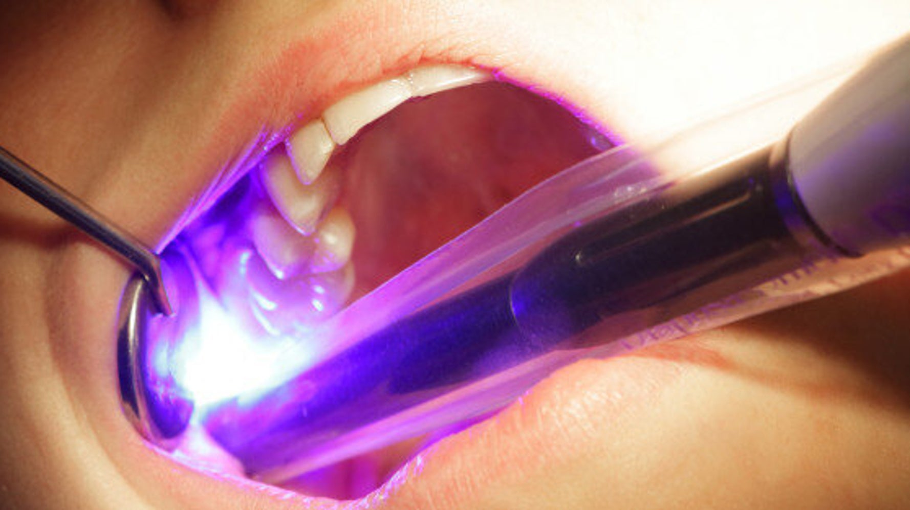 Having More Than Eight Dental Fillings Increases Mercury Levels In Your
